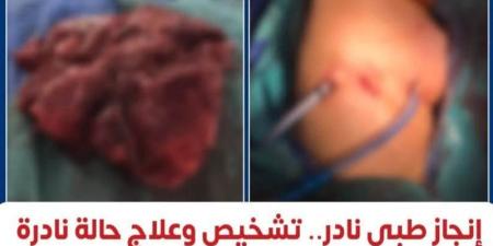 إنجاز طبي نادر، معهد القلب ينجح في تشخيص وعلاج أول حالة موثقة عالميًا لبطانة الرحم داخل الرئة - المدينة برس