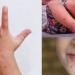 استشاري يكشف أعراض وأسباب متلازمة اليد والقدم والفم عند الأطفال - المدينة برس