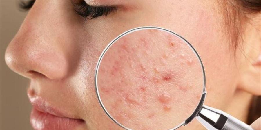 هل ينتقل حب الشباب بالتقبيل؟ طبيب جلدية يحسم الجدل - المدينة برس